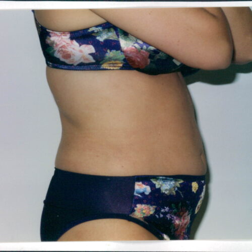 Liposuction Patient 16 - After - 1