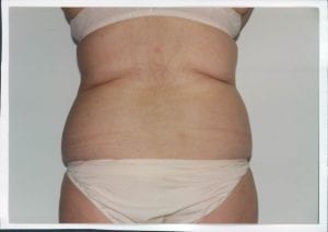Liposuction Patient 16 - Before - 2 Thumbnail