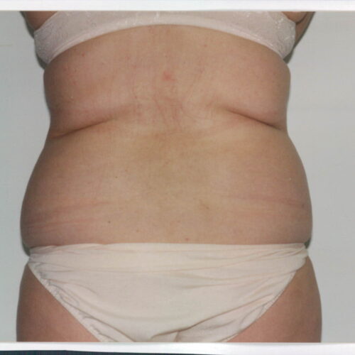 Liposuction Patient 16 - Before - 2