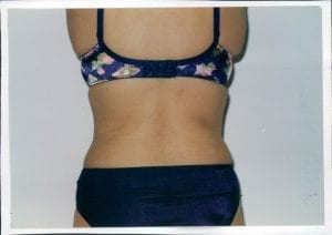 Liposuction Patient 16 - After - 2 Thumbnail