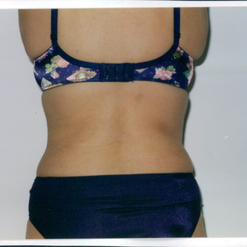 Liposuction Patient 16 - After - 2