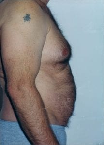 Male Liposuction Patient 06 - Before - 2 Thumbnail