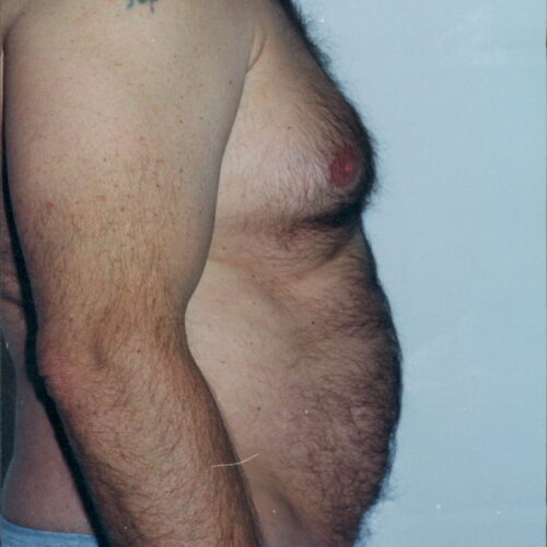 Male Liposuction Patient 06 - Before - 2