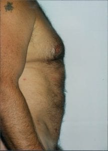 Male Liposuction Patient 06 - After - 2 Thumbnail