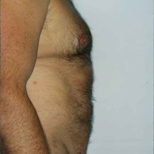 Male Liposuction Patient 06 - After - 2