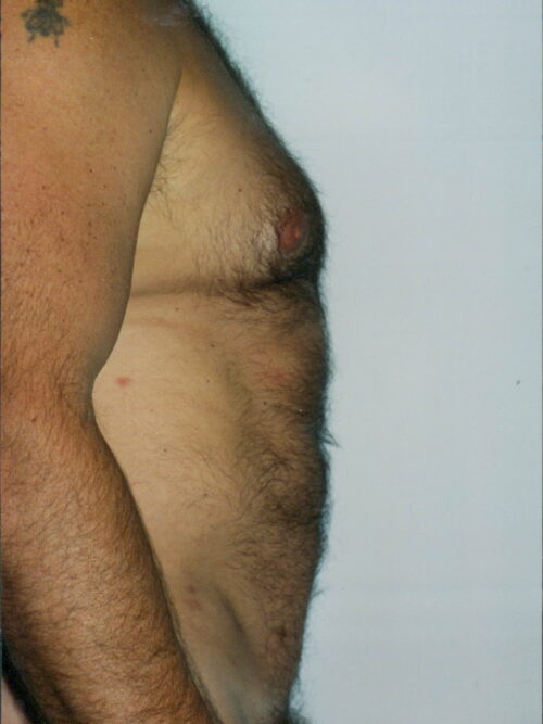 Liposuction Patient 12a - After - 1