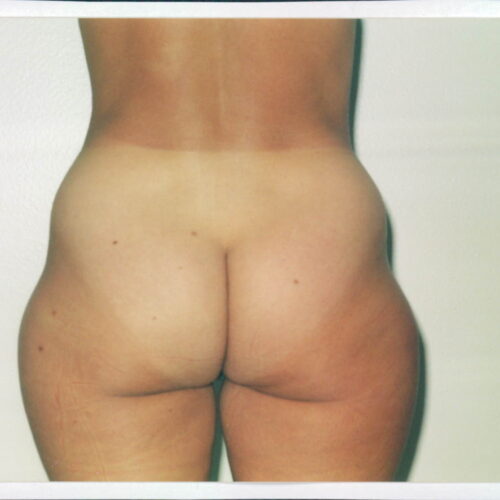 Liposuction Patient 14 - Before - 1