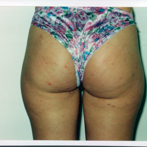Liposuction Patient 13 - Before - 1