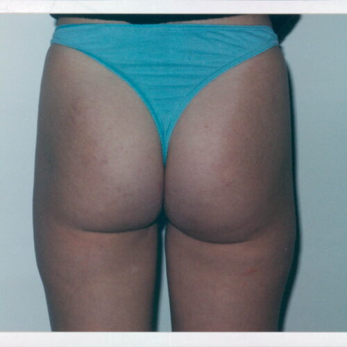 Liposuction Patient 13 - After - 1