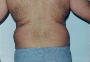 Male Liposuction Patient 06 - Before - 1 Thumbnail