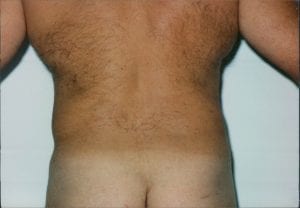 Male Liposuction Patient 06 - After - 1 Thumbnail