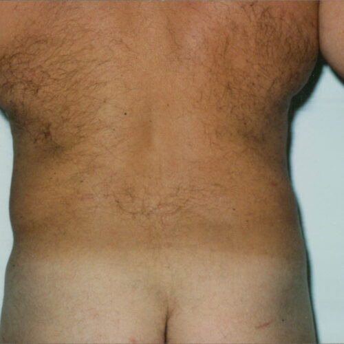 Male Liposuction Patient 06 - After - 1