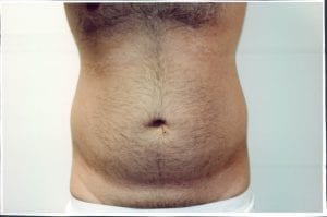 Liposuction Patient 11 - Before - 1 Thumbnail