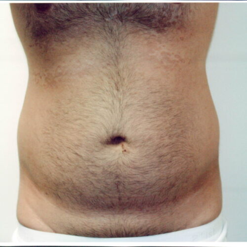 Liposuction Patient 11 - Before - 1