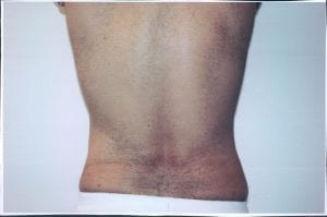 Liposuction Patient 11 - After - 2 Thumbnail