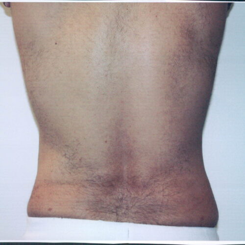Liposuction Patient 11 - After - 2