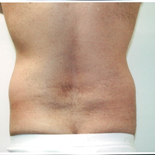 Liposuction Patient 11 - Before - 2