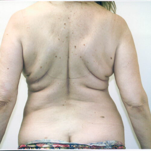 Liposuction Patient 10 - Before - 1