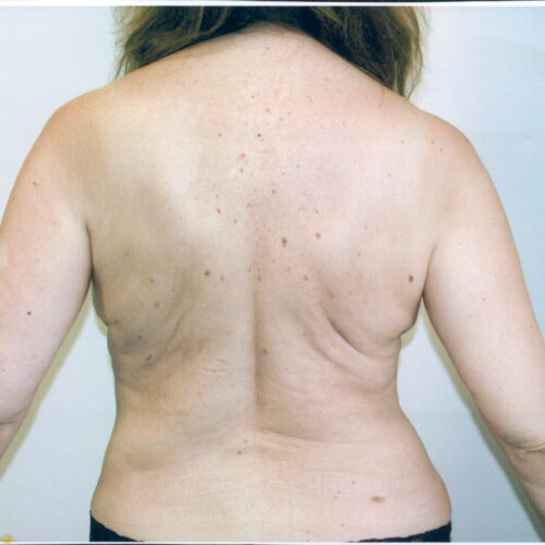 Liposuction Patient 10 - After - 1