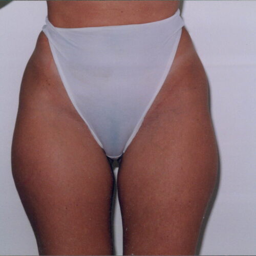 Liposuction Patient 09 - Before - 1