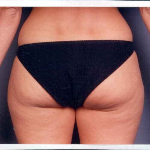 Liposuction Patient 08 - Before - 1