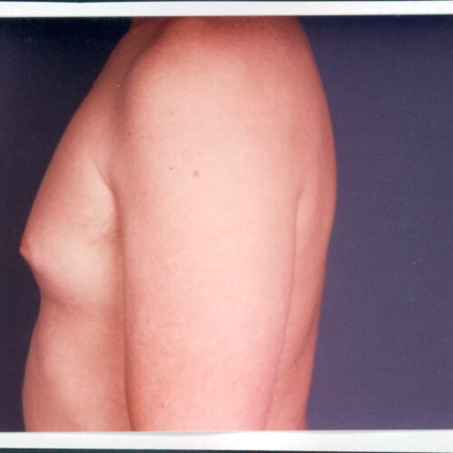 Liposuction Patient 06 - Before - 1