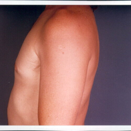 Liposuction Patient 06 - After - 1