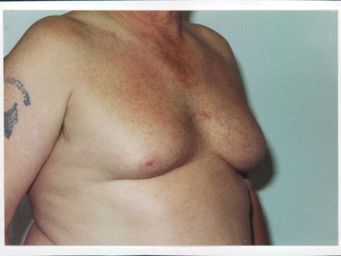 Gynecomastia Patient 04 - Before - 1