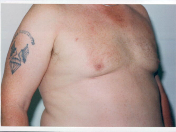 Gynecomastia Patient 04 - After - 1