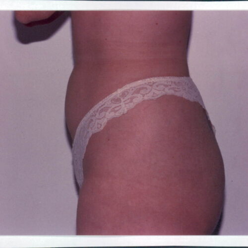 Liposuction Patient 04 - Before - 1