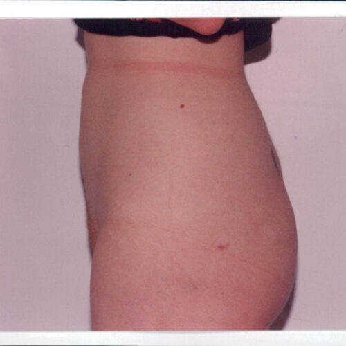 Liposuction Patient 04 - After - 1