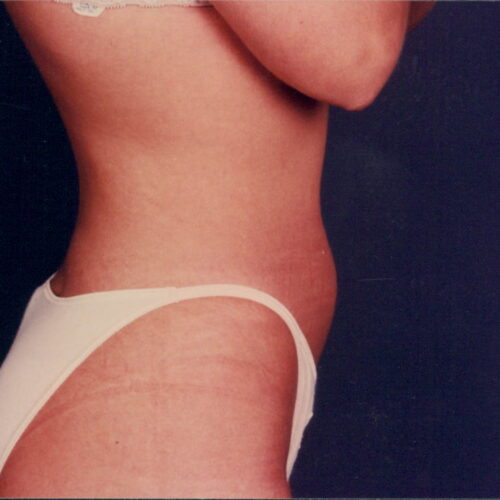 Liposuction Patient 03 - Before - 1