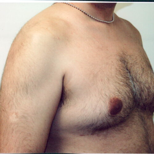 Gynecomastia Patient 03 - Before - 1