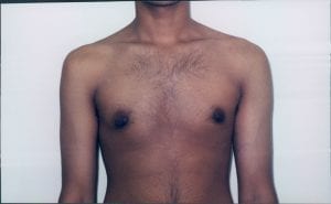 Gynecomastia Patient 02 - After - 1 Thumbnail