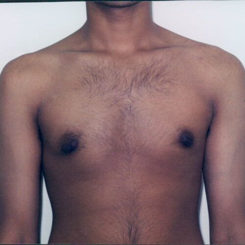 Gynecomastia Patient 02 - After - 1