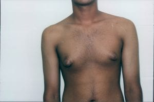 Gynecomastia Patient 02 - Before - 1 Thumbnail