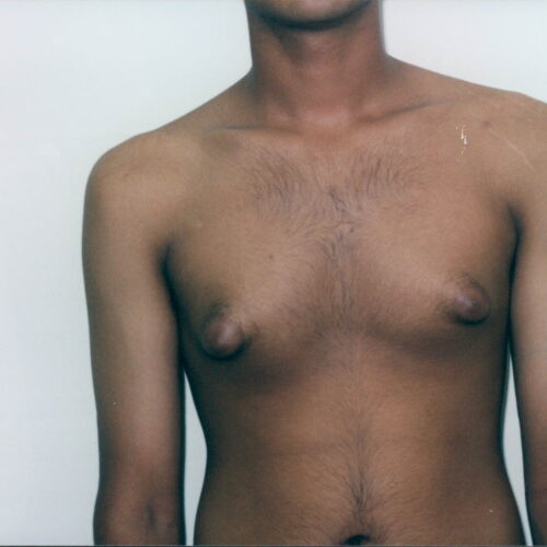 Gynecomastia Patient 02 - Before - 1