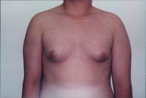 Gynecomastia Patient 01 - After - 1 Thumbnail