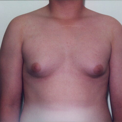 Gynecomastia Patient 01 - After - 1