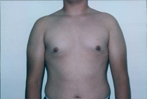 Gynecomastia Patient 01 - Before - 1 Thumbnail