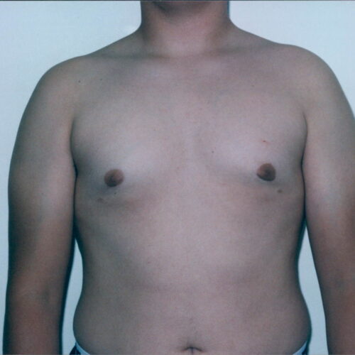 Gynecomastia Patient 01 - Before - 1