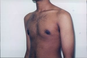 Gynecomastia Patient 02 - After - 2 Thumbnail