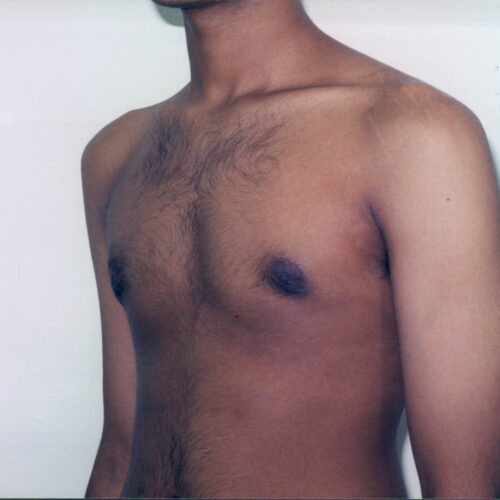 Gynecomastia Patient 02 - After - 2