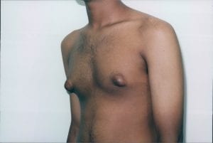 Gynecomastia Patient 02 - Before - 2 Thumbnail