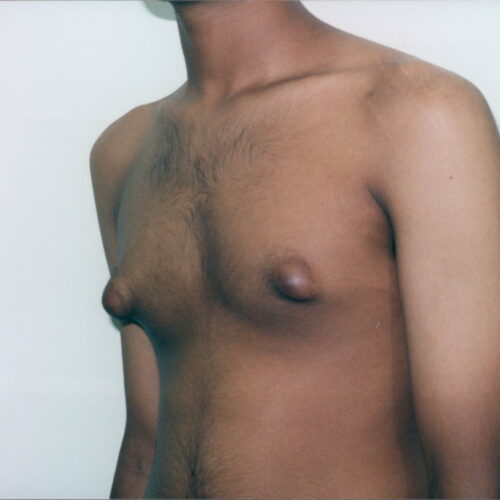 Gynecomastia Patient 02 - Before - 2