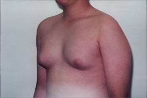 Gynecomastia Patient 01 - Before - 2 Thumbnail