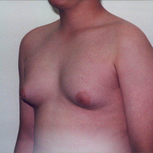 Gynecomastia Patient 01 - Before - 2