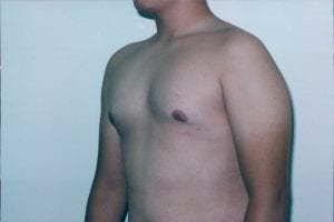 Gynecomastia Patient 01 - After - 2 Thumbnail