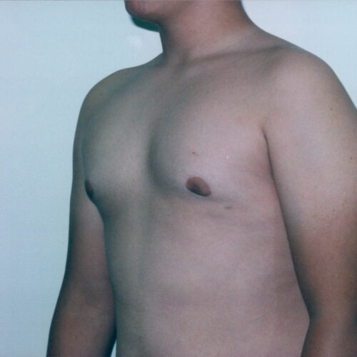 Gynecomastia Patient 01 - After - 2