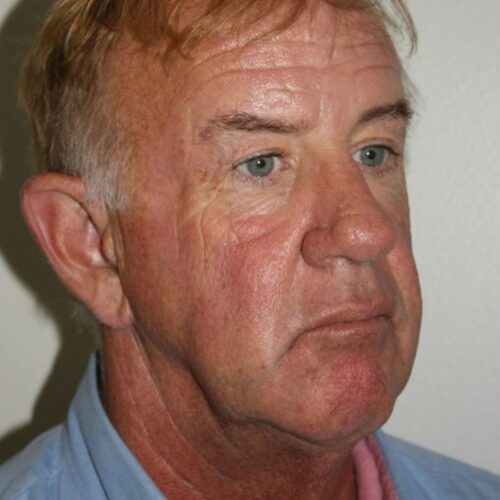 Male Facelift Patient 02 - Before - 2